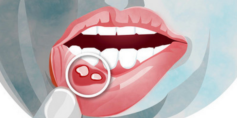 口腔溃疡的一些最常见原因