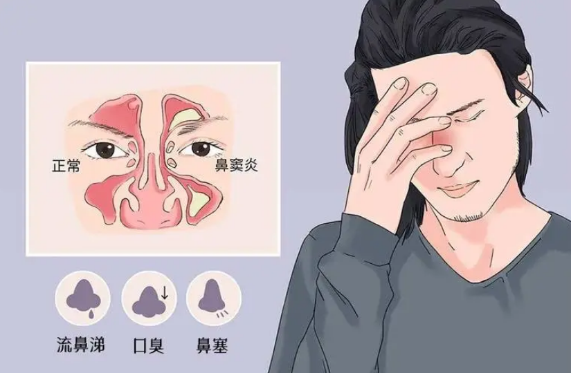 为什么鼻炎要调理肠道，原因在这里！